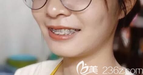 看到我在上海臻威口腔矯正齙牙+深覆蓋1年的效果圖，我不后悔沒(méi)有選擇做正畸