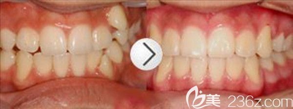 牙齒矯正前后效果圖