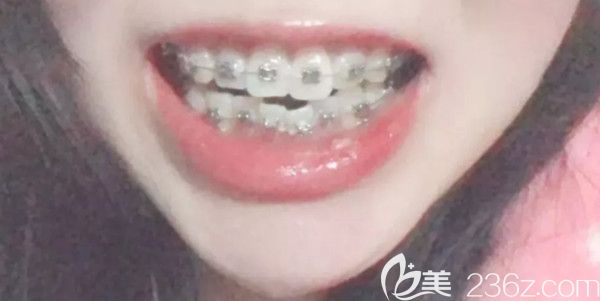 金屬托槽矯正第二個(gè)月變化圖