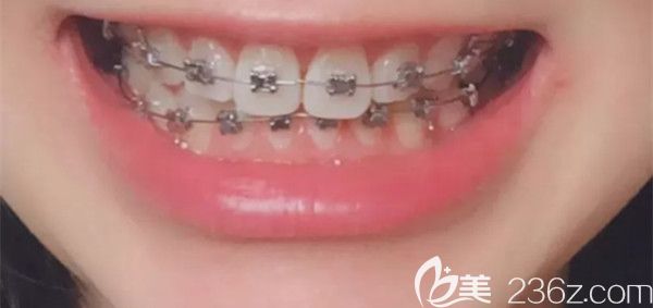 在口腔拔了四顆智齒后正畸，曬半年來的牙齒矯正變化圖