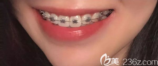 口腔正畸第四個(gè)月效果圖