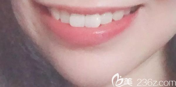 牙齒矯正前的照片