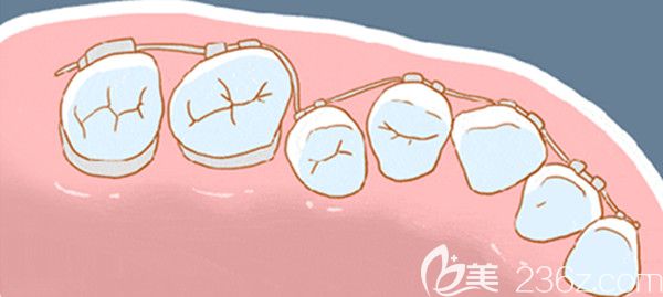 牙齒不整齊需做口腔正畸