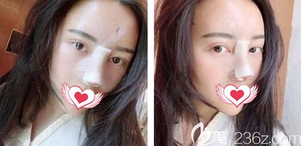 隆鼻失敗修復(fù)第3天腫脹感減輕了