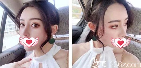 鼻修復(fù)手術(shù)一個(gè)月現(xiàn)在基本已經(jīng)定型