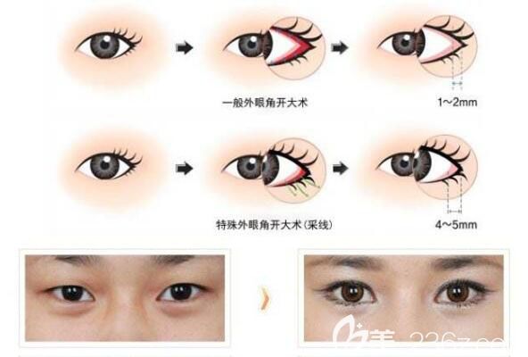 開眼角前后對比照片圖