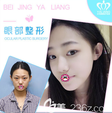 北京雅靚岳才醫(yī)生眼綜合案例