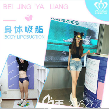 北京雅靚陳林葉醫(yī)生腰腹吸脂案例 北京雅靚陳林葉醫(yī)生腰腹吸脂案例
