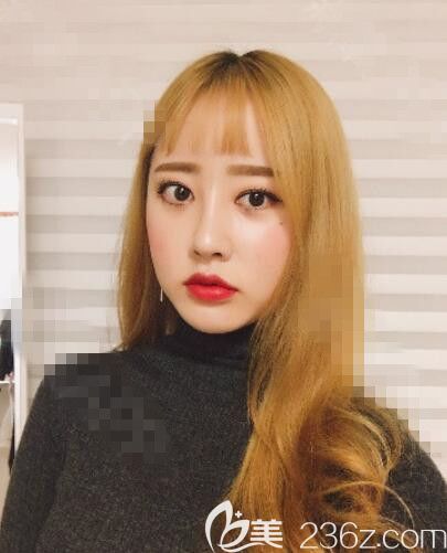 首爾麗絲塔金東奭鼻綜合雙眼皮修復(fù)線提升脂肪填充術(shù)后由路人甲變女神你們覺得呢