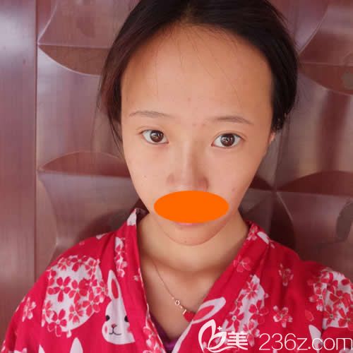 沒去贛州亞韓整形做prp自體脂肪填充全臉前照片 沒去贛州亞韓整形做prp自體脂肪填充全臉前照片