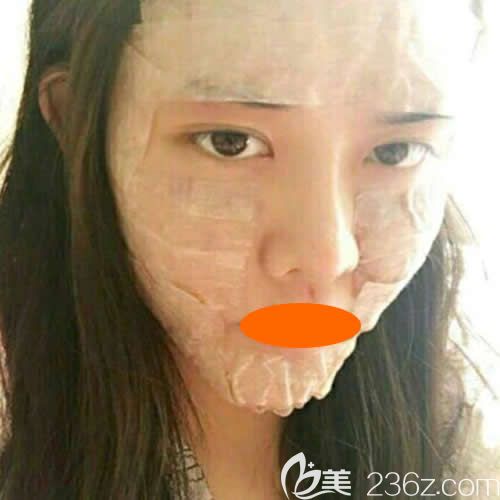 到贛州亞韓整形找聶云飛主任做prp自體脂肪填充全臉術(shù)后第2天效果 到贛州亞韓整形找聶云飛主任做prp自體脂肪填充全臉術(shù)后第2天效果