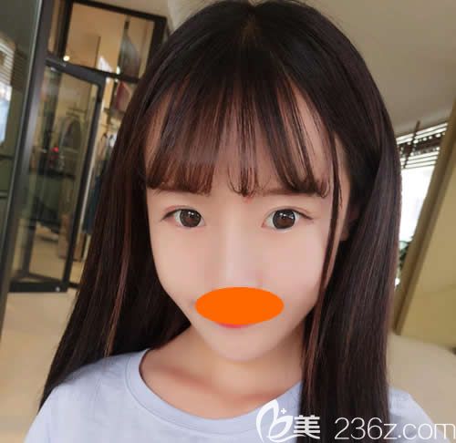 到贛州亞韓整形做prp自體脂肪填充全臉術(shù)后第36天效果 到贛州亞韓整形做prp自體脂肪填充全臉術(shù)后第36天效果