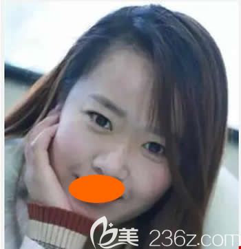 沒去西寧時光整形美容醫(yī)院割雙眼皮+假體隆鼻前照片 沒去西寧時光整形美容醫(yī)院割雙眼皮+假體隆鼻前照片