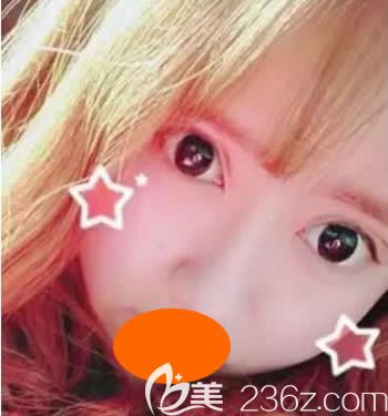 我到西寧時光整形割雙眼皮+假體隆鼻綜合手術(shù)后第18天<span style= 我到西寧時光整形割雙眼皮+假體隆鼻綜合手術(shù)后第18天<span style=