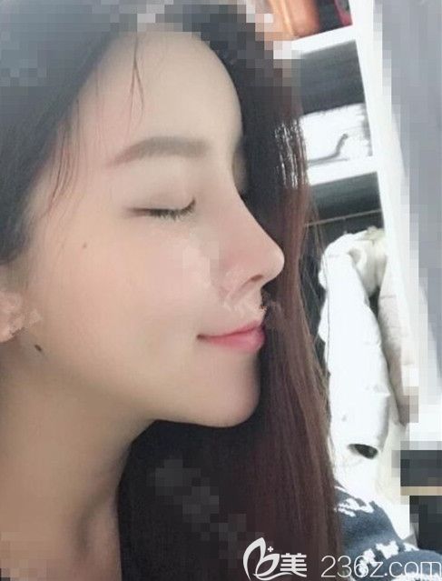 韓國DI整形醫(yī)院李玟榮：半肋骨鼻修復后原諒我自戀感覺美到炸