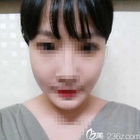 韓國(guó)愛(ài)我整形醫(yī)院面部輪廓怎么樣？樸范鎮(zhèn)案例