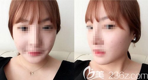 聊下我找韓國愛我整形醫(yī)院樸范鎮(zhèn)做3D顴骨顴弓整形對(duì)比照+長曲線下頜角后的感受