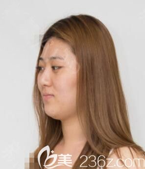 術(shù)前 術(shù)前