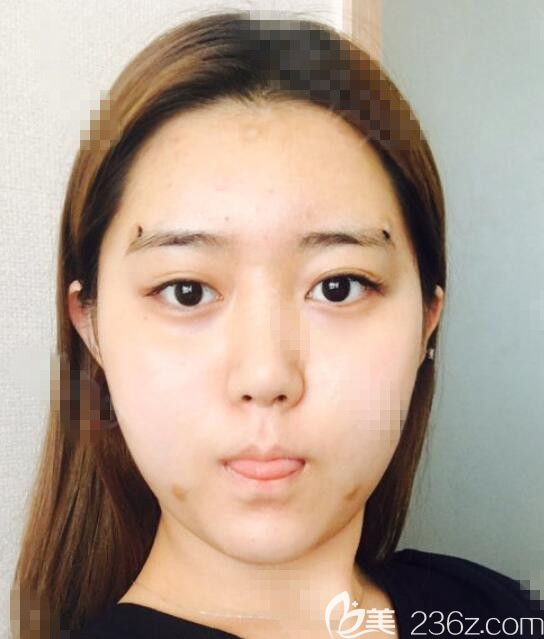 韓國(guó)維摩做面部脂肪填充怎么樣 韓國(guó)維摩做面部脂肪填充怎么樣