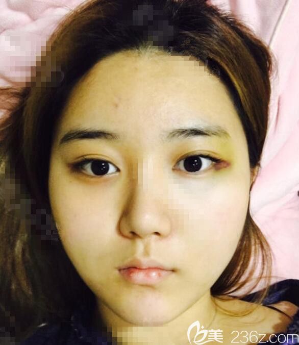 韓國(guó)維摩脂肪填充真人案例 韓國(guó)維摩脂肪填充真人案例