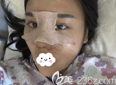 成都銅雀臺(tái)鼻綜合術(shù)后3天效果圖