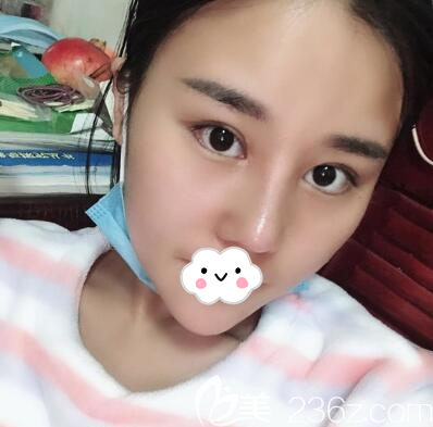 肋軟骨隆鼻拆線后側(cè)臉效果