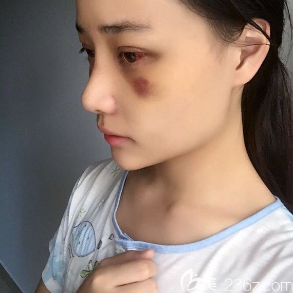 韓國自然主義雙眼皮+假體隆鼻綜合整形術(shù)后一周恢復(fù)效果圖