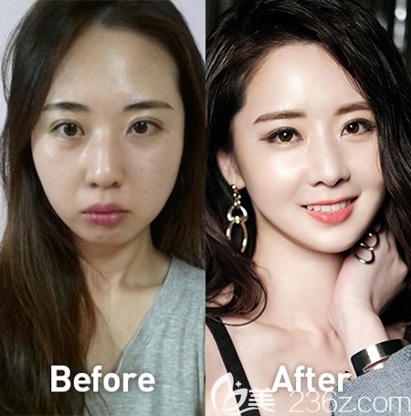 韓國(guó)必嫵整形醫(yī)院面部輪廓案例