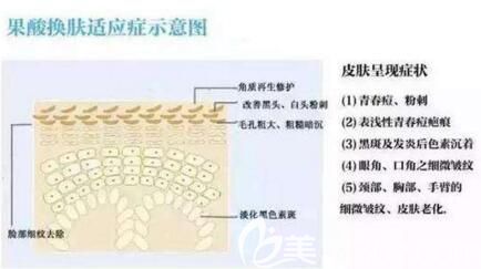 果酸換膚適應(yīng)癥示意圖