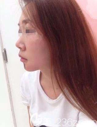 面診蘇州衛(wèi)康術前塌鼻子 面診蘇州衛(wèi)康術前塌鼻子