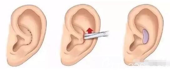 耳軟骨隆鼻取骨位置 耳軟骨隆鼻取骨位置