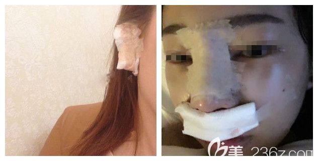 剛做完自體耳軟骨鼻綜合術后即刻效果 剛做完自體耳軟骨鼻綜合術后即刻效果