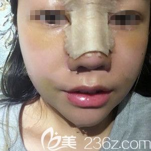 術后三天鼻綜合恢復效果 術后三天鼻綜合恢復效果