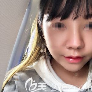 自體耳軟骨+硅膠隆鼻術后半個月效果 自體耳軟骨+硅膠隆鼻術后半個月效果