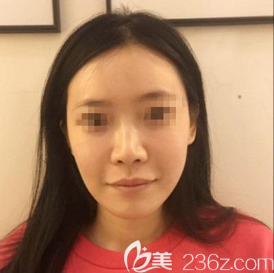 在韓國(guó)寶士麗做自體脂肪填充+鼻綜合手術(shù)前 在韓國(guó)寶士麗做自體脂肪填充+鼻綜合手術(shù)前