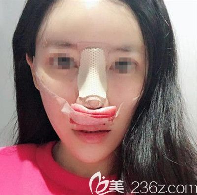 在韓國(guó)寶士麗做自體脂肪填充+鼻綜合手術(shù)當(dāng)天 在韓國(guó)寶士麗做自體脂肪填充+鼻綜合手術(shù)當(dāng)天