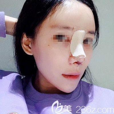 在韓國(guó)寶士麗做自體脂肪填充+鼻綜合手術(shù)后3天 在韓國(guó)寶士麗做自體脂肪填充+鼻綜合手術(shù)后3天