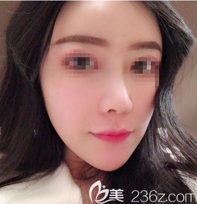 在韓國(guó)寶士麗做自體脂肪填充+鼻綜合手術(shù)后2周 在韓國(guó)寶士麗做自體脂肪填充+鼻綜合手術(shù)后2周