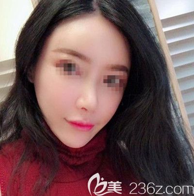 在韓國(guó)寶士麗做自體脂肪填充+鼻綜合手術(shù)后1個(gè)月 在韓國(guó)寶士麗做自體脂肪填充+鼻綜合手術(shù)后1個(gè)月