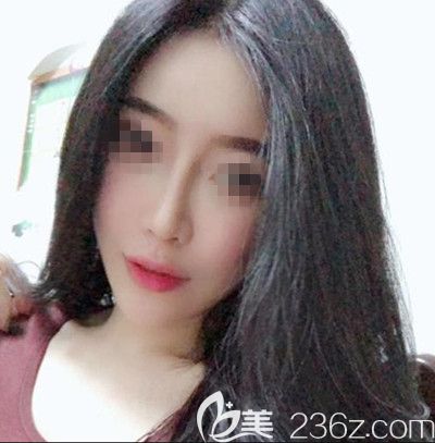 在韓國(guó)寶士麗做自體脂肪填充+鼻綜合手術(shù)后2個(gè)月 在韓國(guó)寶士麗做自體脂肪填充+鼻綜合手術(shù)后2個(gè)月