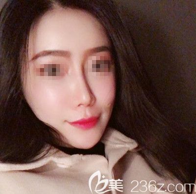 在韓國(guó)寶士麗做自體脂肪填充+鼻綜合手術(shù)后3個(gè)月 在韓國(guó)寶士麗做自體脂肪填充+鼻綜合手術(shù)后3個(gè)月