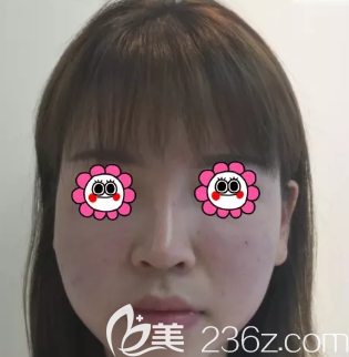 吸脂術(shù)前照片 吸脂術(shù)前照片