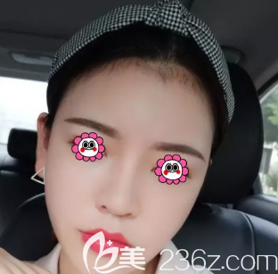 我是3月在淄博美冠臣做了面部吸脂手術，姐妹們可以參考一下哦