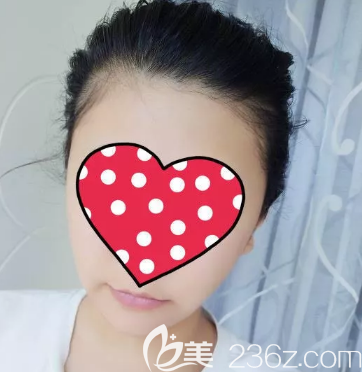 面部吸脂一個月之后的樣子