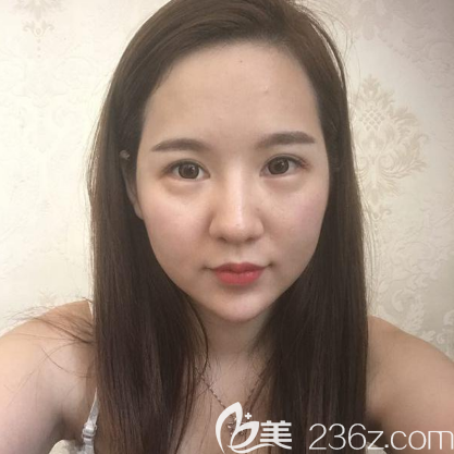 去廣州藝美做眼鼻修復(fù)前的樣子 去廣州藝美做眼鼻修復(fù)前的樣子