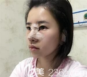 做完隆鼻后的即刻<span style=