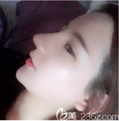 廣州藝美雙眼皮隆鼻修復(fù)術(shù)后7天拆線 廣州藝美雙眼皮隆鼻修復(fù)術(shù)后7天拆線