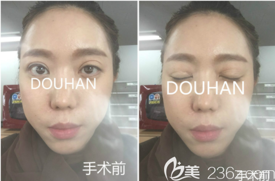 韓國(guó)枓翰整形申科翰做眼修復(fù)怎么樣 韓國(guó)枓翰整形申科翰做眼修復(fù)怎么樣