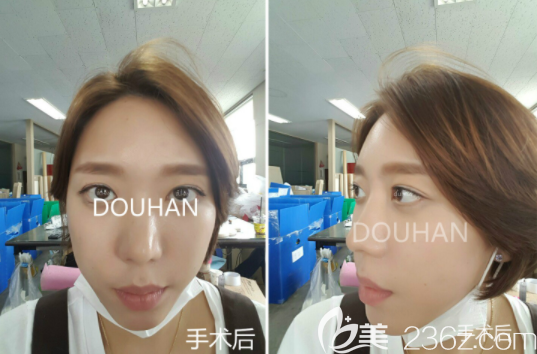 慘痛經(jīng)歷雙眼皮失敗第三次在韓國(guó)枓翰整形申科翰修復(fù)