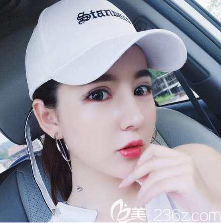 廣州藝美李闖做的鼻綜合隆鼻修復(fù)效果 廣州藝美李闖做的鼻綜合隆鼻修復(fù)效果